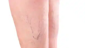 tratamiento para eliminar arañas vasculares y varices