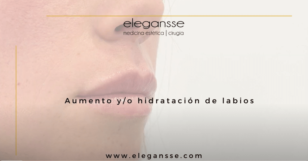 Diseño de Labios con Ácido Hialurónico