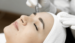 microneedling en Barcelona