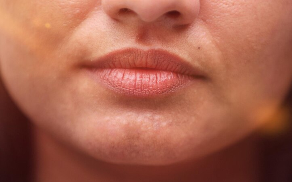 Cita tratar labios deshidratados Barcelona