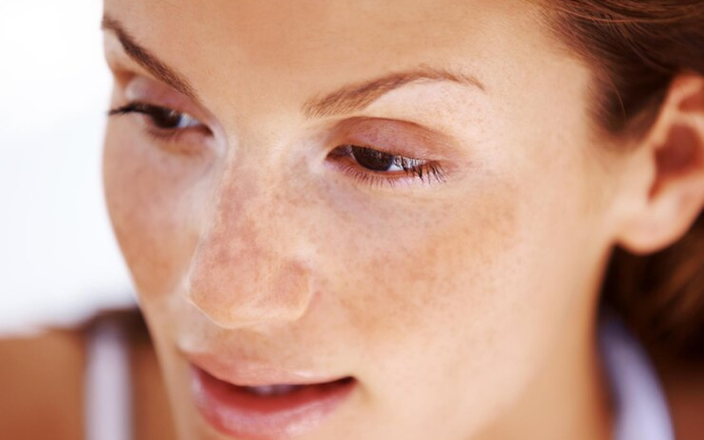 DUDAS sobre el tratamiento para melasma en Barcelona