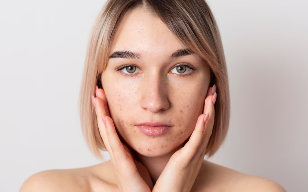 Dermapen para cicatrices de acné BARCELONA