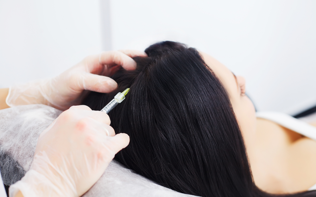 Tratamiento de Mesoterapia para la caída del pelo en Barcelona