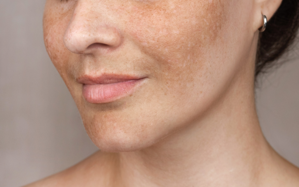 Tratamiento Melasma Tratamiento facial Barcelona