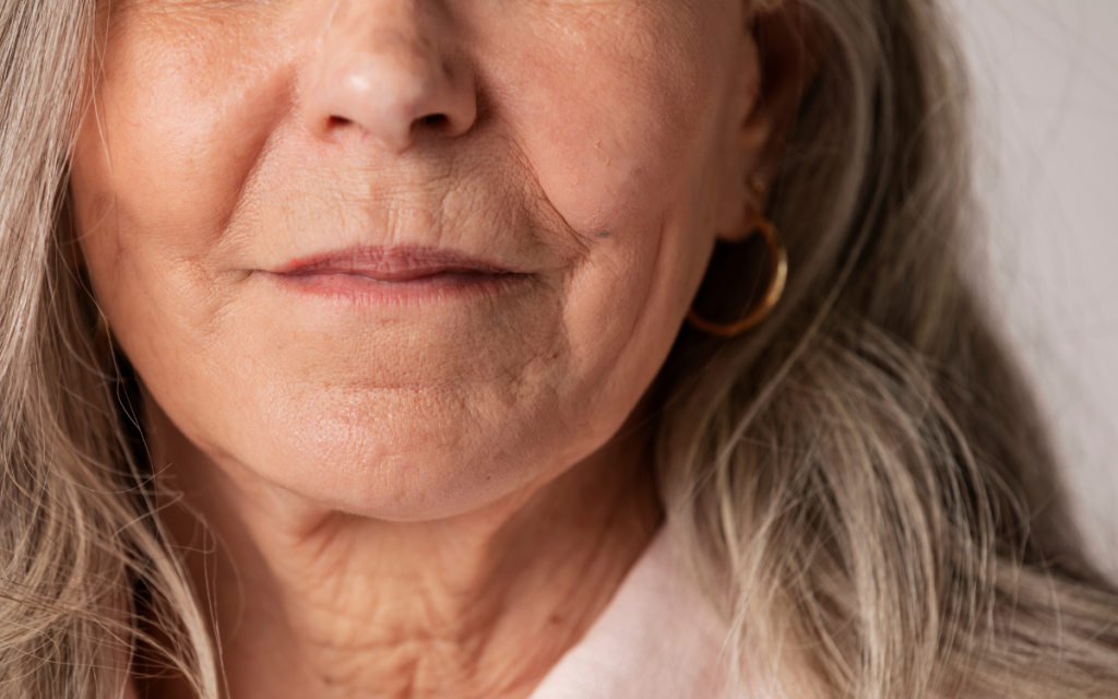 Tratamiento Surco nasogeniano Tratamiento facial Barcelona
