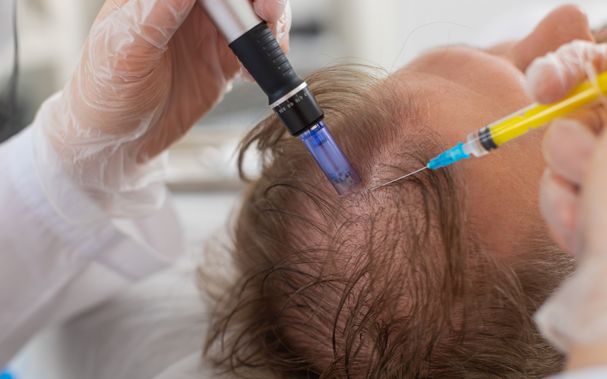 Tratamiento de Dermapen en Barcelona