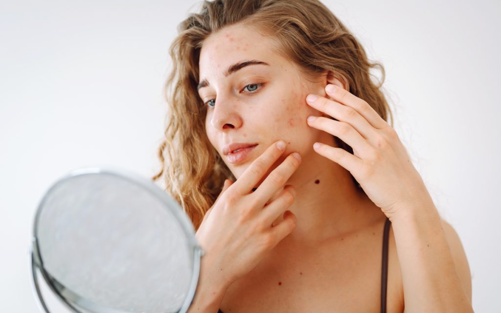 Tratamiento para Acné Tratamiento facial en Barcelona
