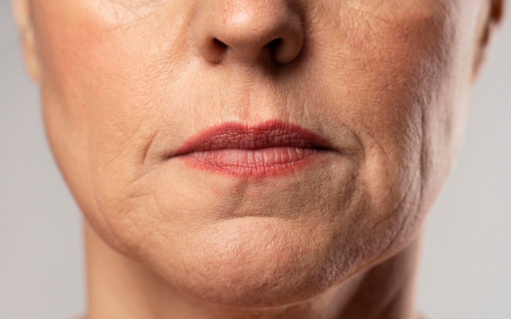 Tratamiento para Arrugas en mentón Tratamiento facial Barcelona