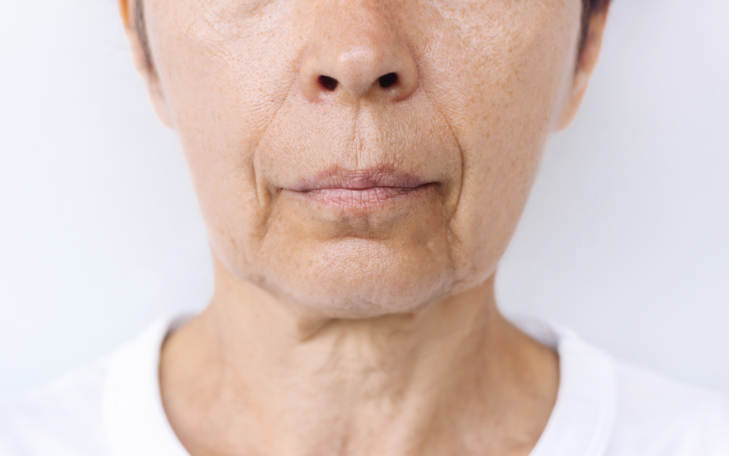 _Tratamiento para Líneas de marioneta Tratamiento facial Barcelona