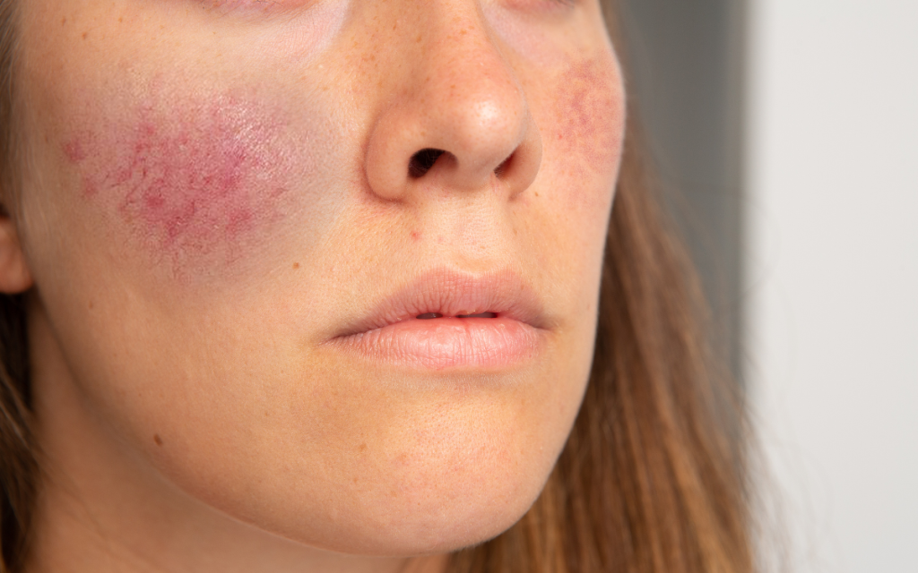 Tratamiento para Telangiectasias Tratamiento facial Barcelona