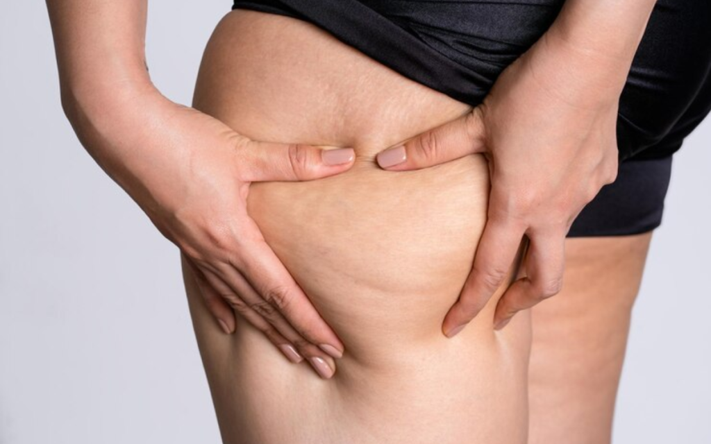 Bioestimulador de colágeno para celulitis corporal BARCELONA