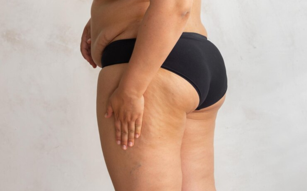 Cavitación para celulitis corporal BARCELONA
