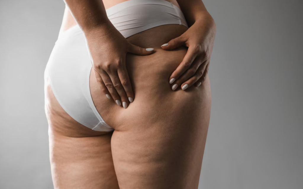 Celulitis BARCELONA