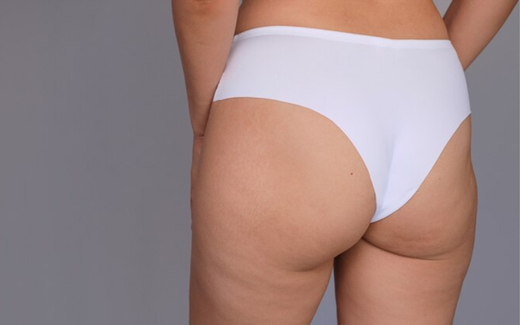 Mesoterapia para celulitis corporal BARCELONA