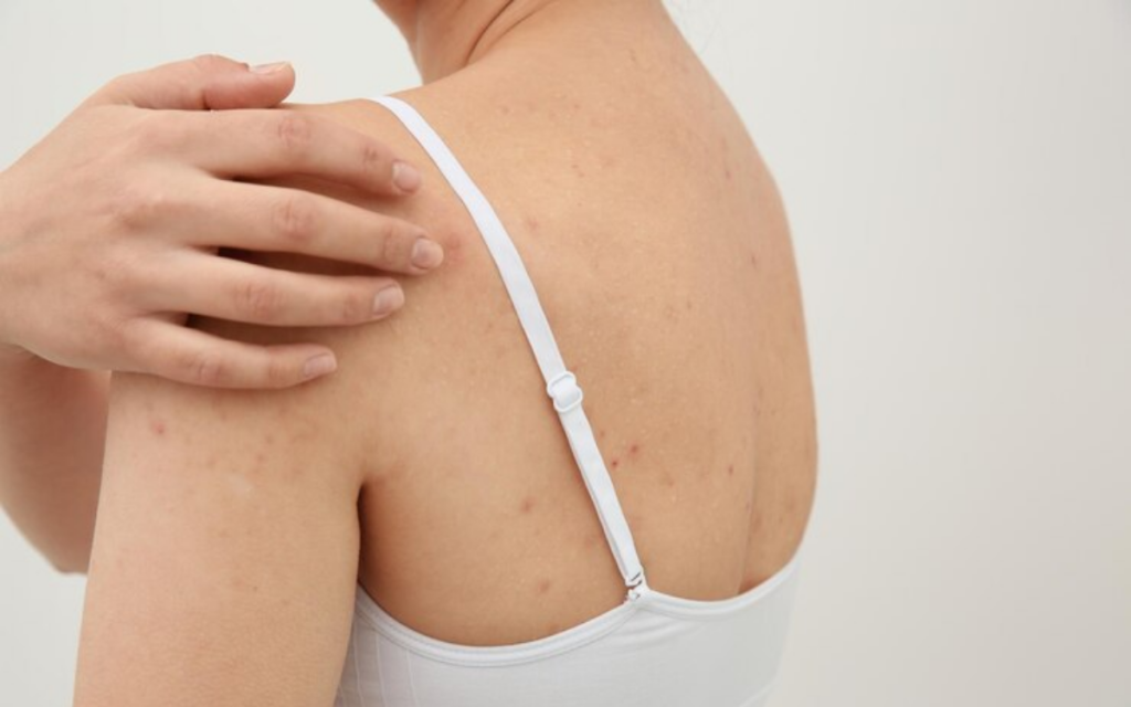 Peeling químico para hiperpigmentación corporal_ BARCELONA