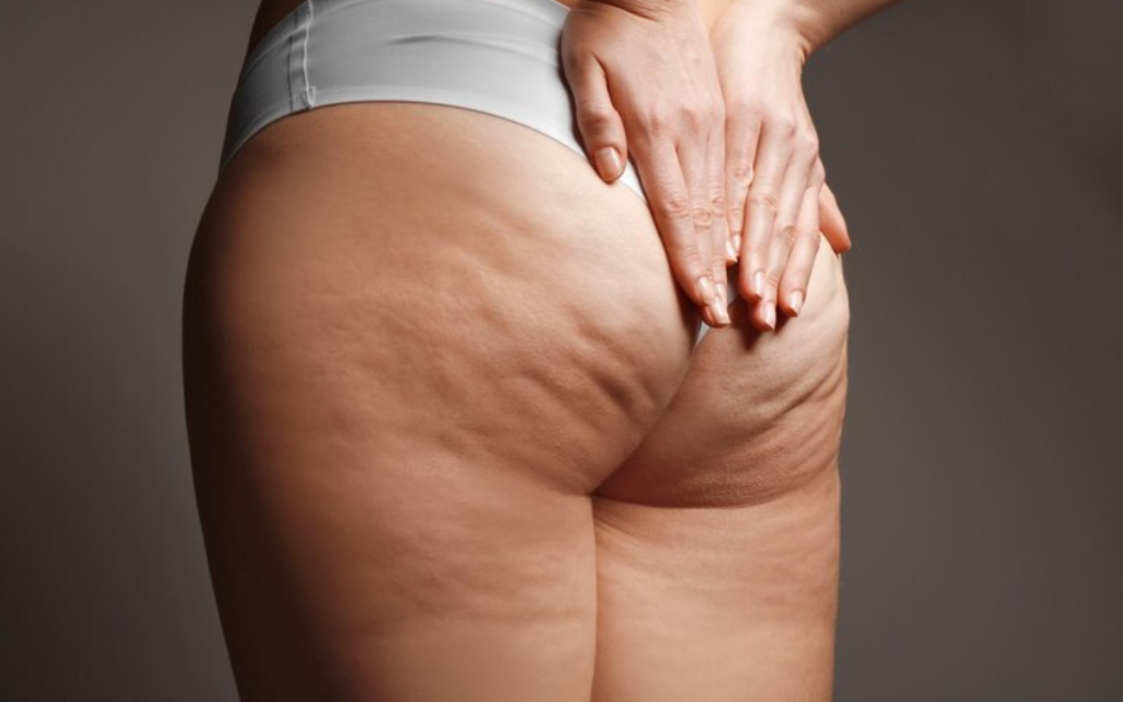 Radiofrecuencia médica para celulitis corporal_ BARCELONA