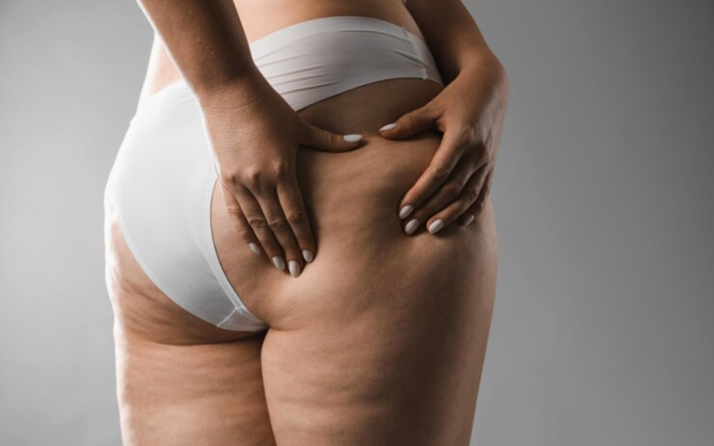 Subscisión para celulitis corporal BARCELONA